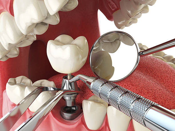 Best Emergency Dentist for Lost Fillings or Crowns in Crafton, PA